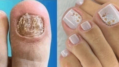 Micose de Unha