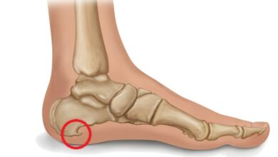 Tratamento Caseiro para Esporão de Calcâneo