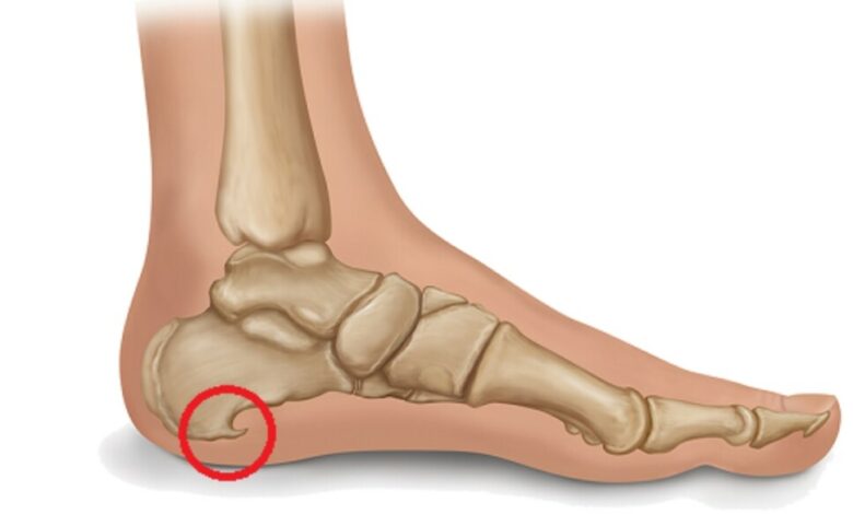 Tratamento Caseiro para Esporão de Calcâneo